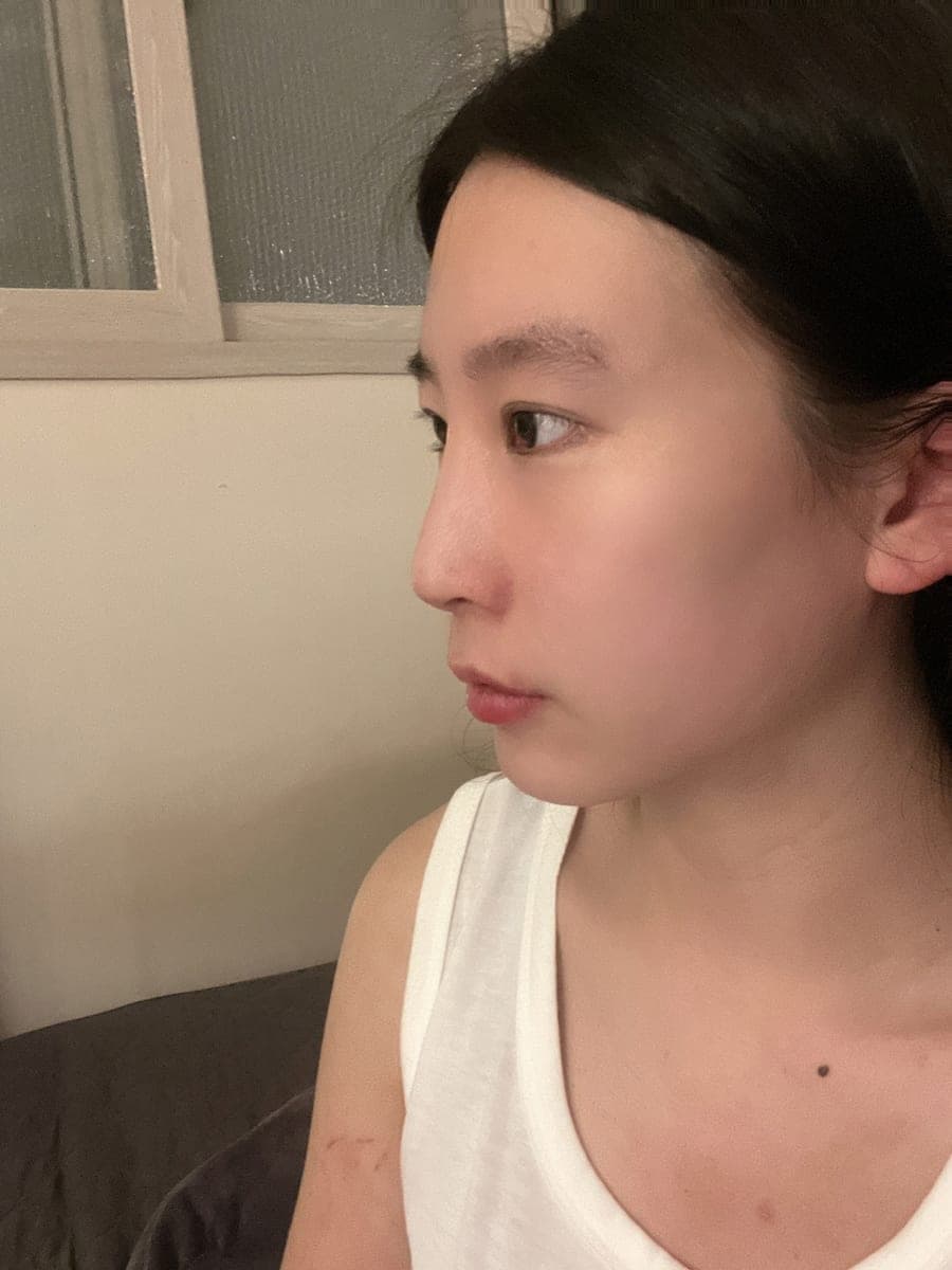 Bridge raised with own cartilage