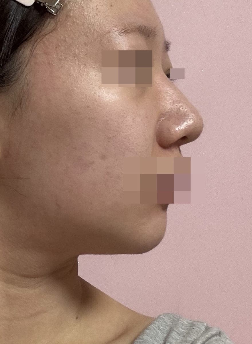 Bulbous tip and nose tip refined together + osteotomy
