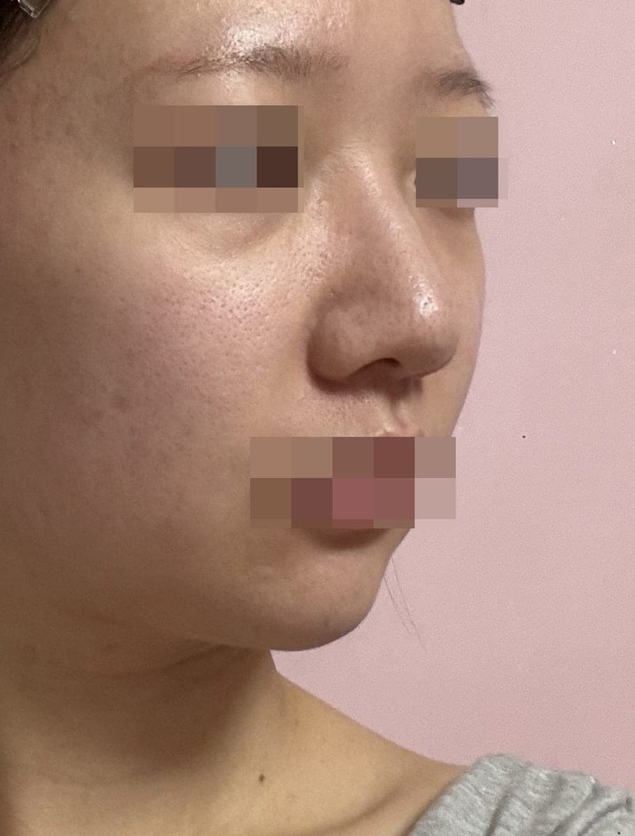Bulbous tip and nose tip refined together + osteotomy