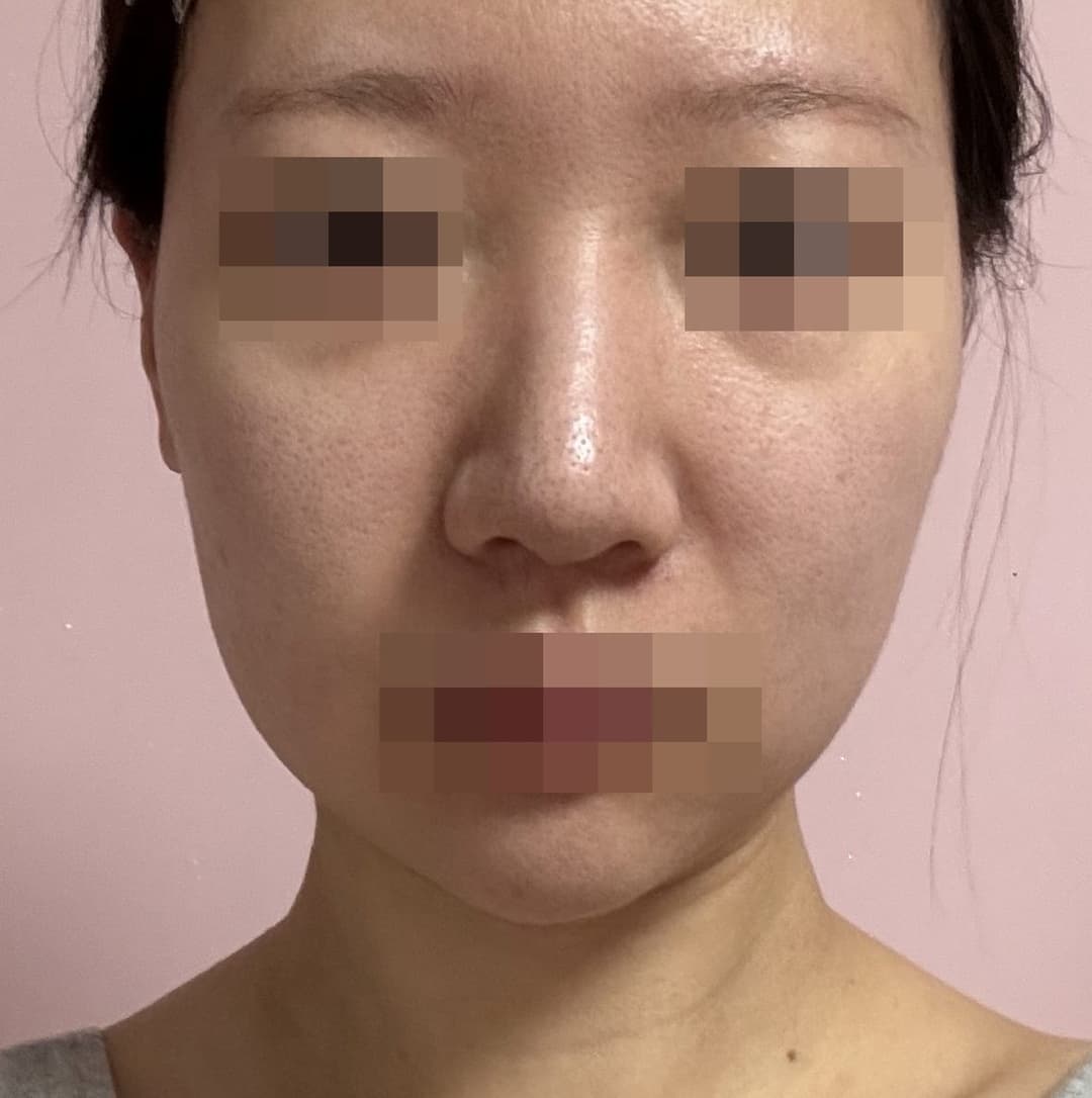 Bulbous tip and nose tip refined together + osteotomy