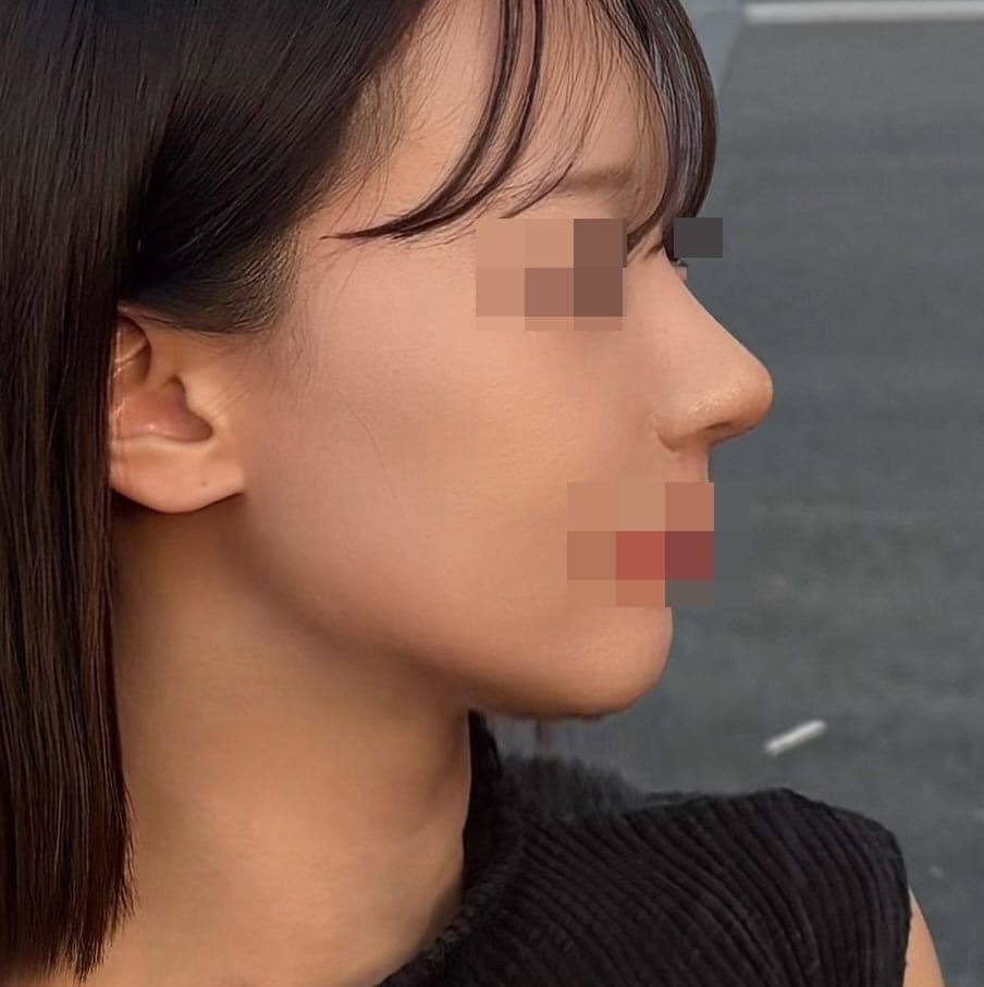 Bulbous tip and nose tip refined together + osteotomy