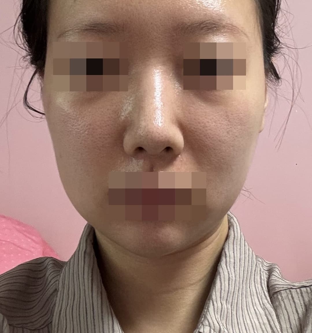 Bulbous tip and nose tip refined together + osteotomy