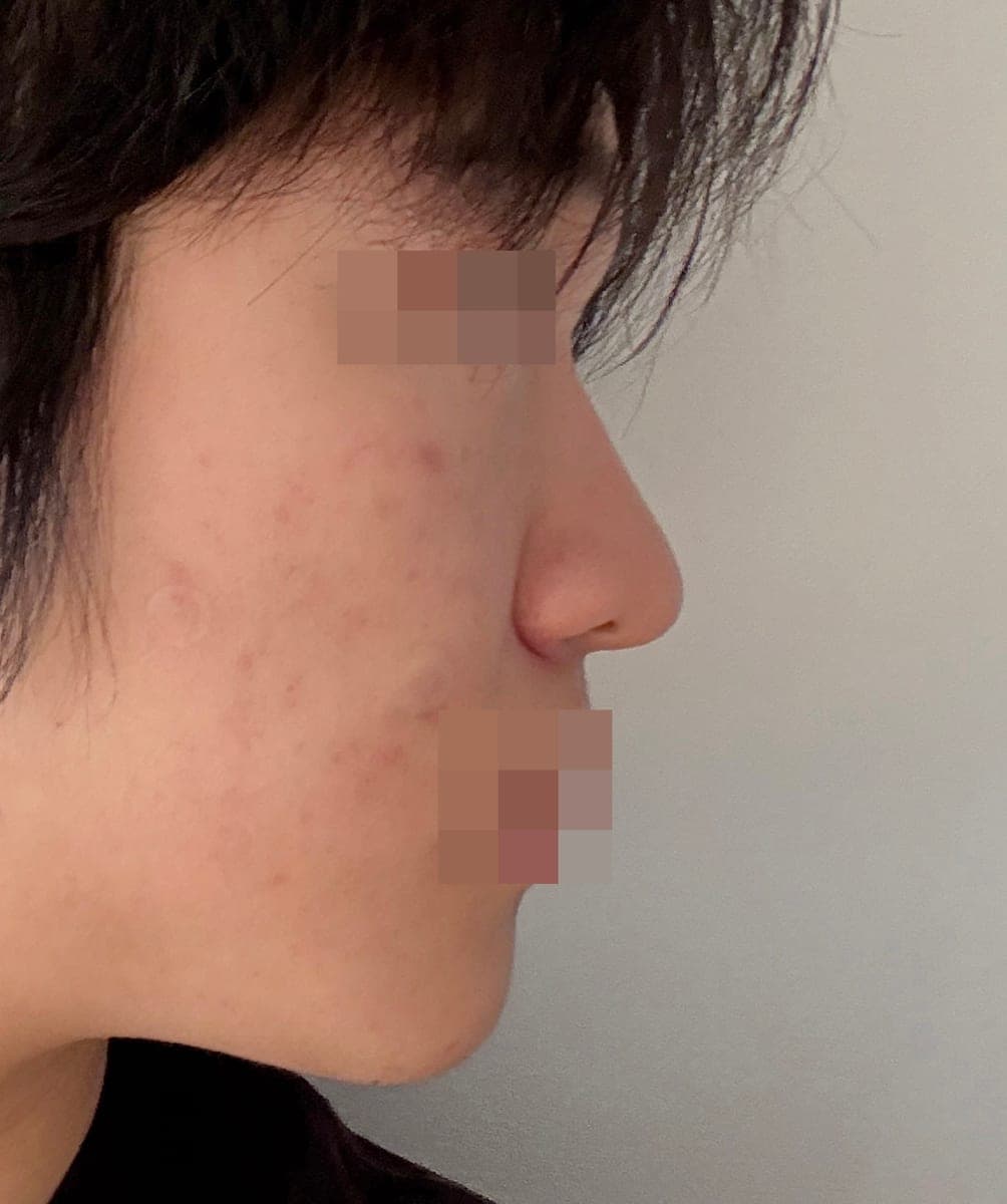 A thick tip made slimmer with own cartilage