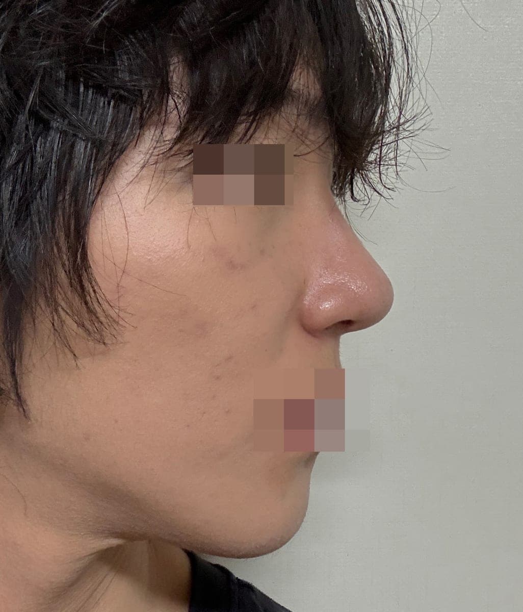 A thick tip made slimmer with own cartilage