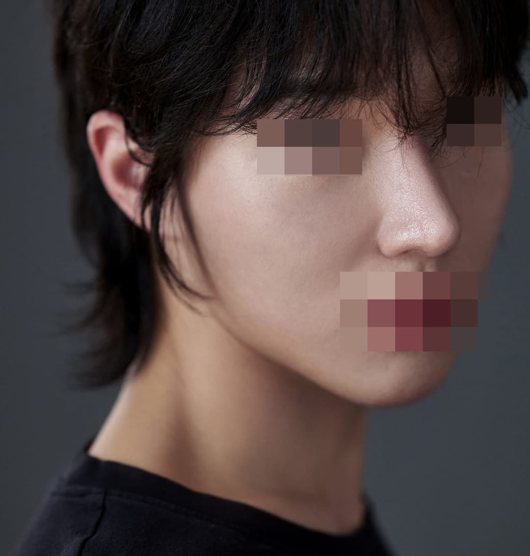 A thick tip made slimmer with own cartilage