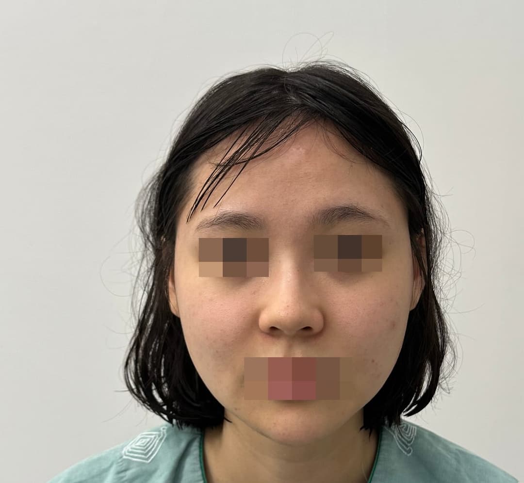 Hooked nose correction