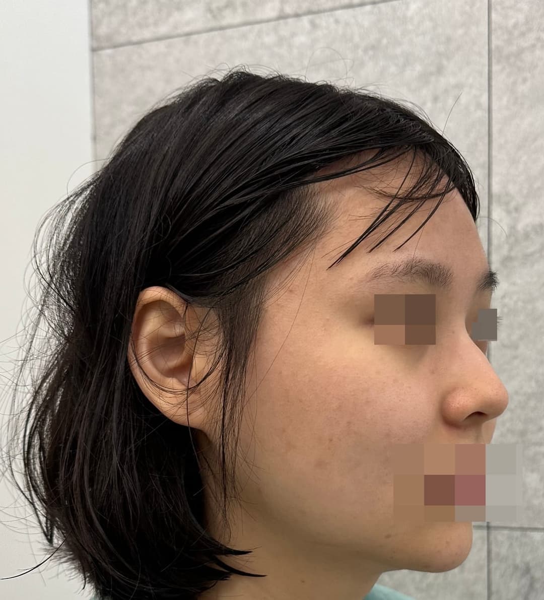 Hooked nose correction