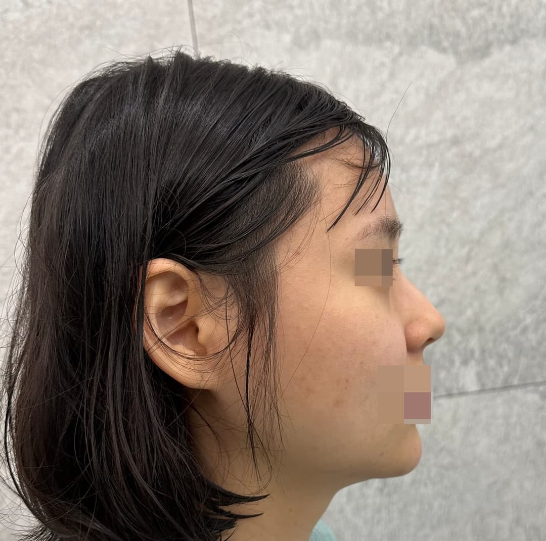 Hooked nose correction
