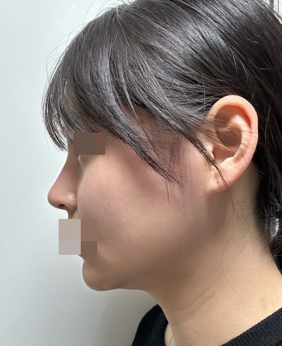 Hooked nose correction