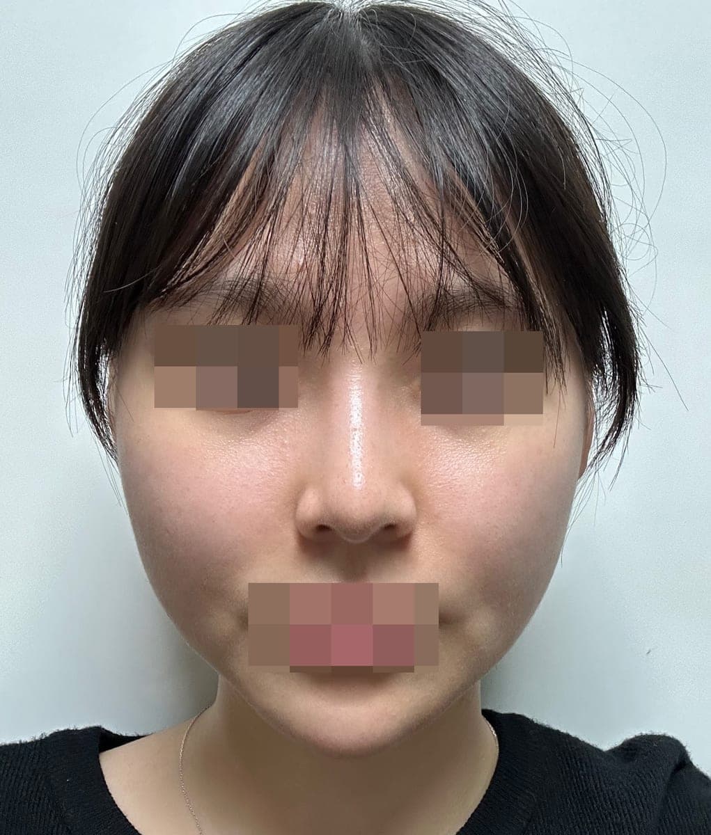 Hooked nose correction