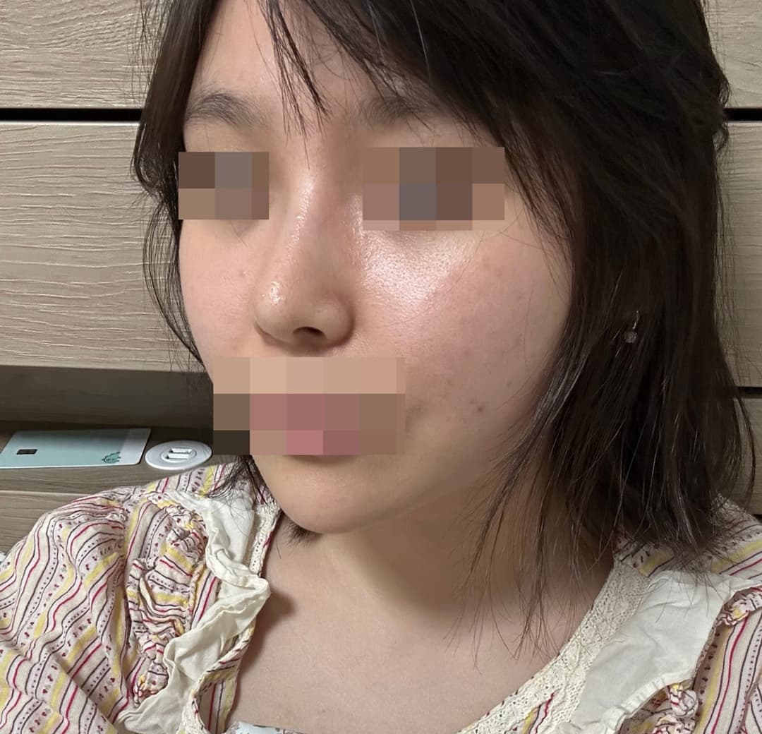 Hooked nose correction