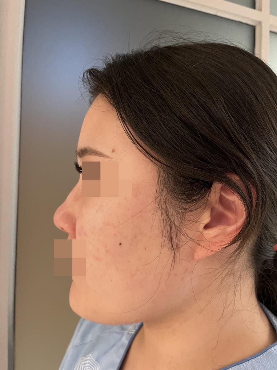Reshaping the profile line