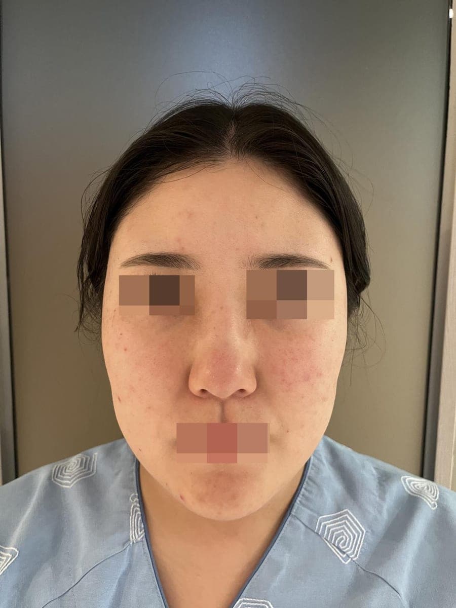 Reshaping the profile line