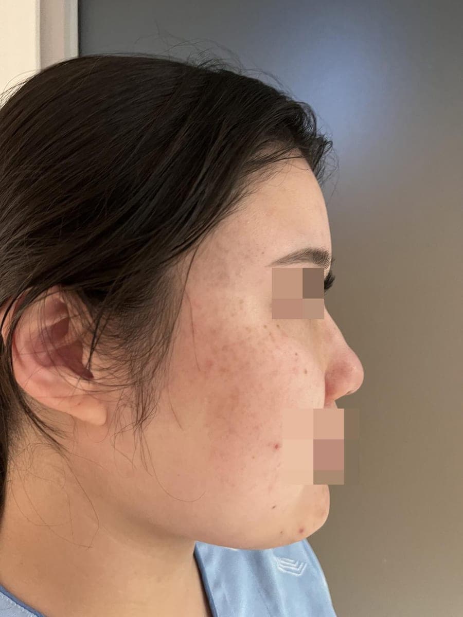 Reshaping the profile line