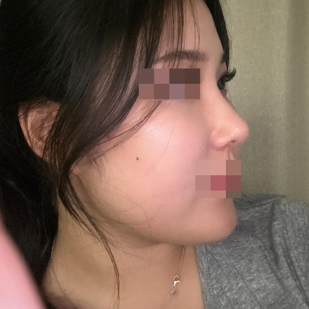 Reshaping the profile line