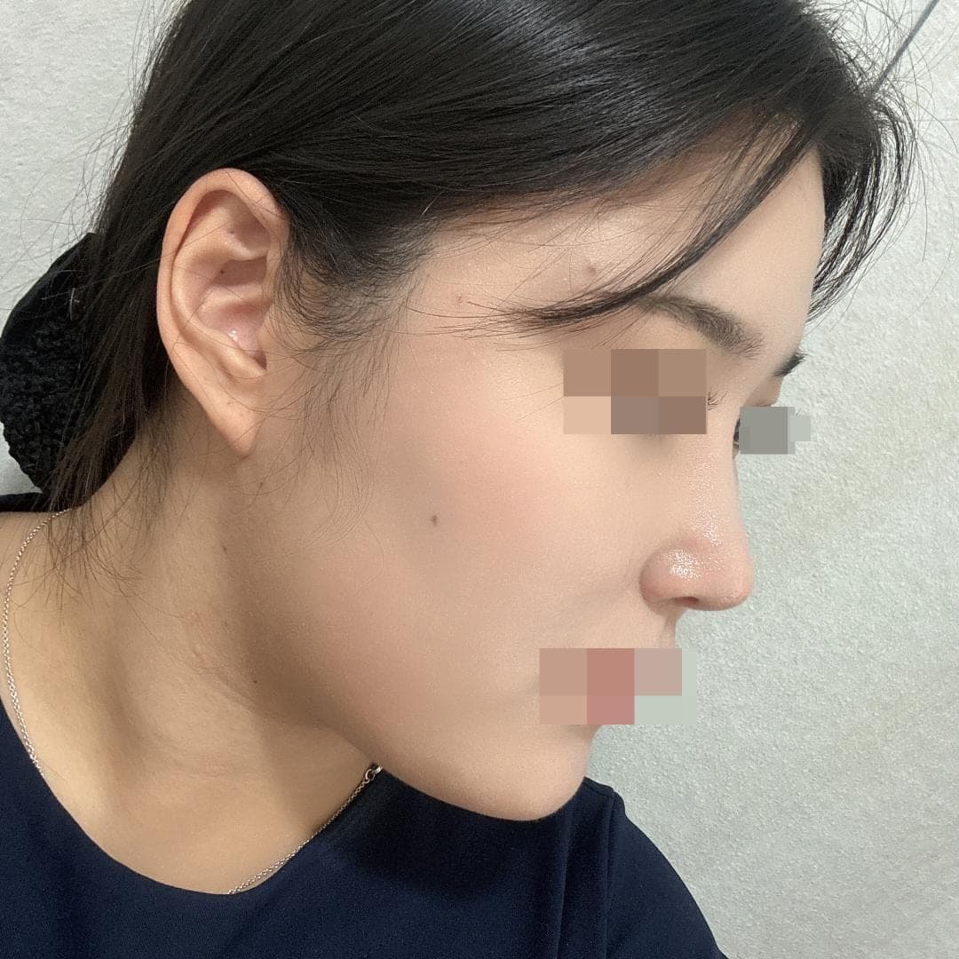 Reshaping the profile line
