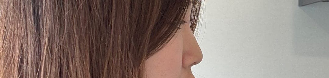 Smoothing a protruding bridge with donor cartilage