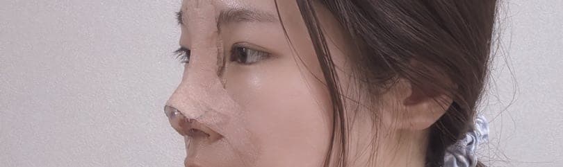 Smoothing a protruding bridge with donor cartilage