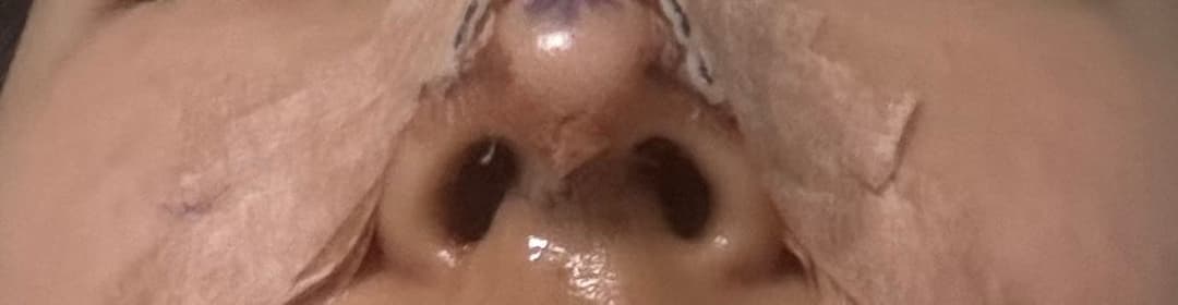 Smoothing a protruding bridge with donor cartilage