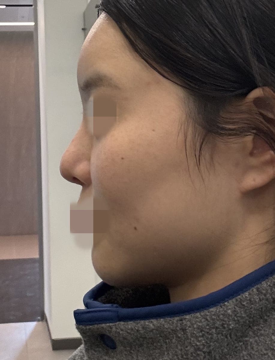 Revision rhinoplasty, tip with own cartilage