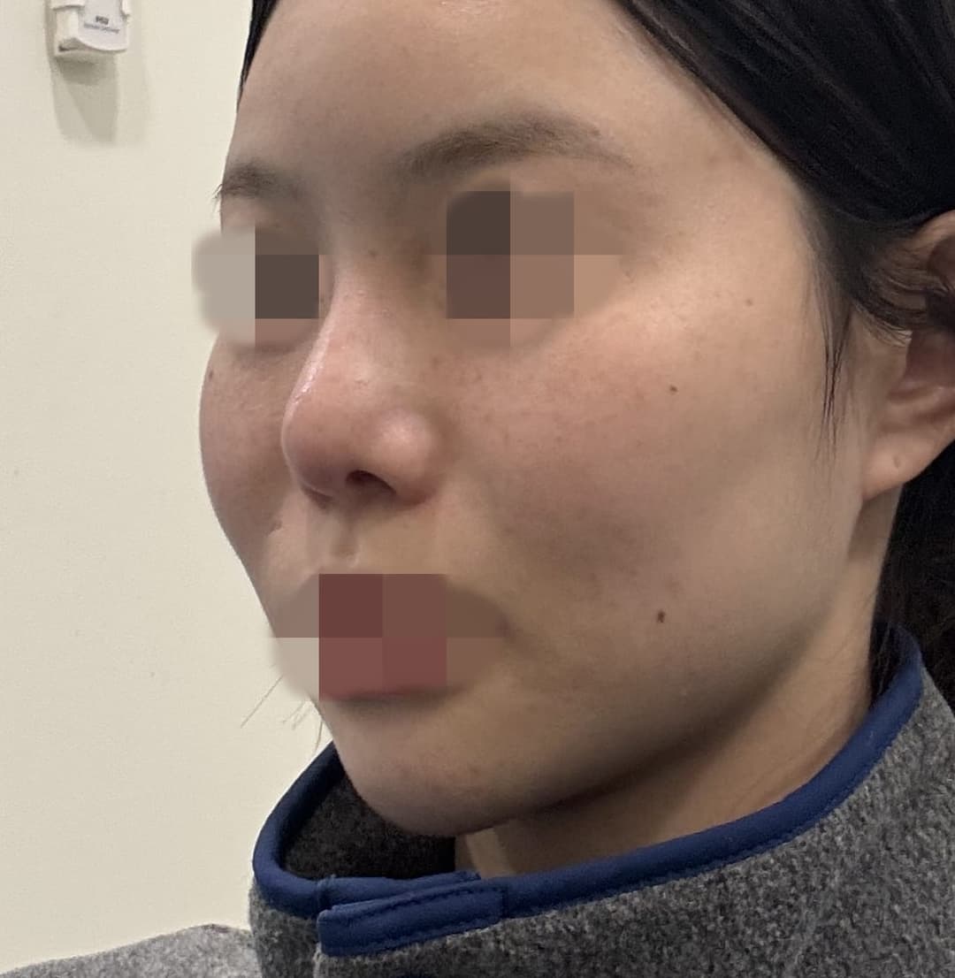 Revision rhinoplasty, tip with own cartilage