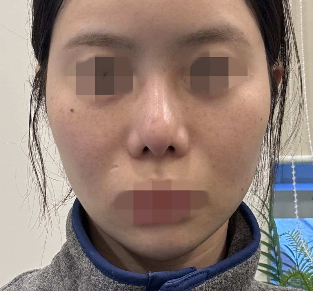 Revision rhinoplasty, tip with own cartilage