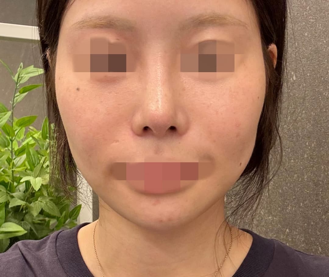 Revision rhinoplasty, tip with own cartilage