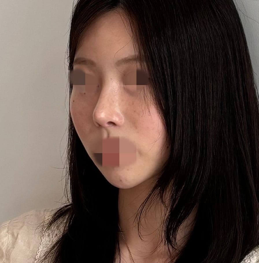Revision rhinoplasty, tip with own cartilage