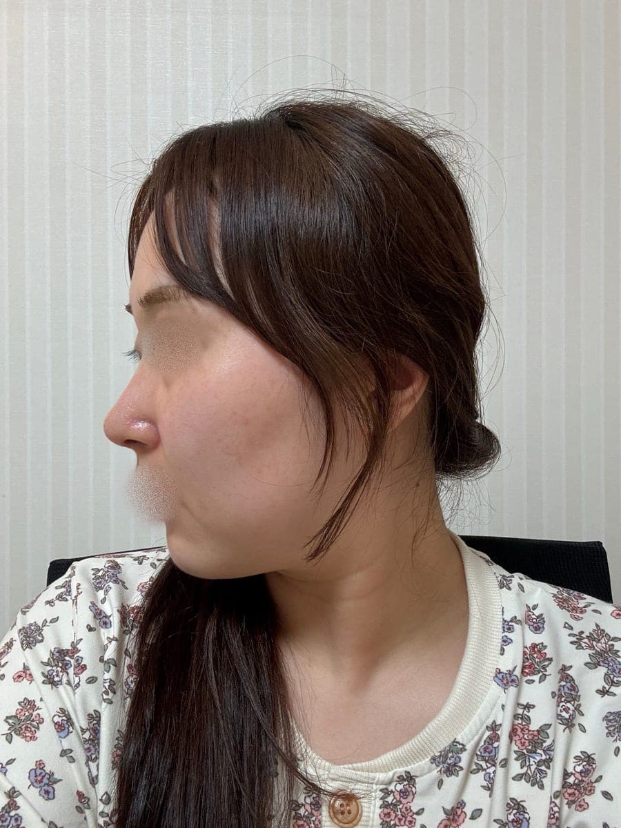 Building the tip with donor cartilage + osteotomy