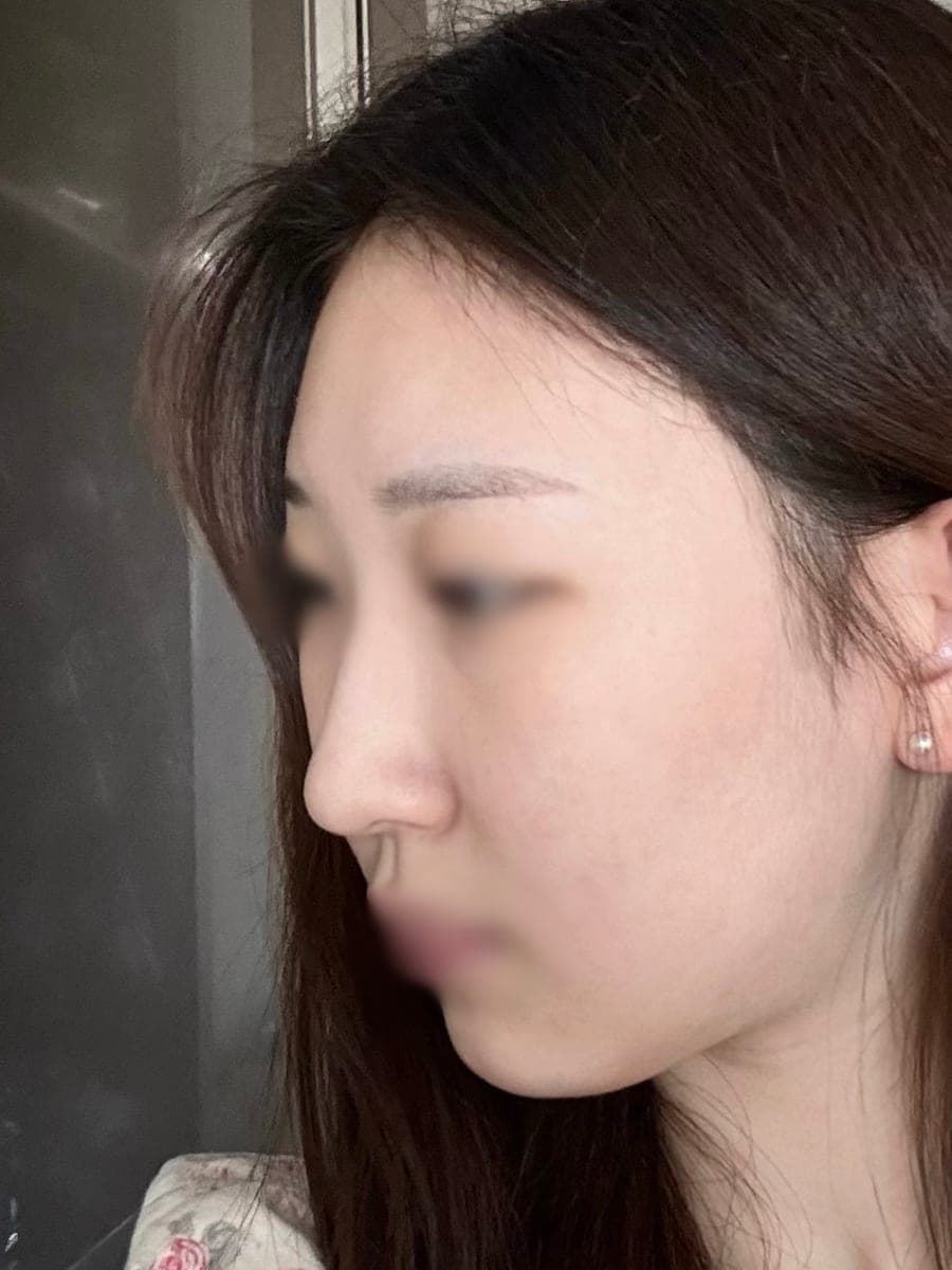Bulbous tip and nose tip refined together + osteotomy