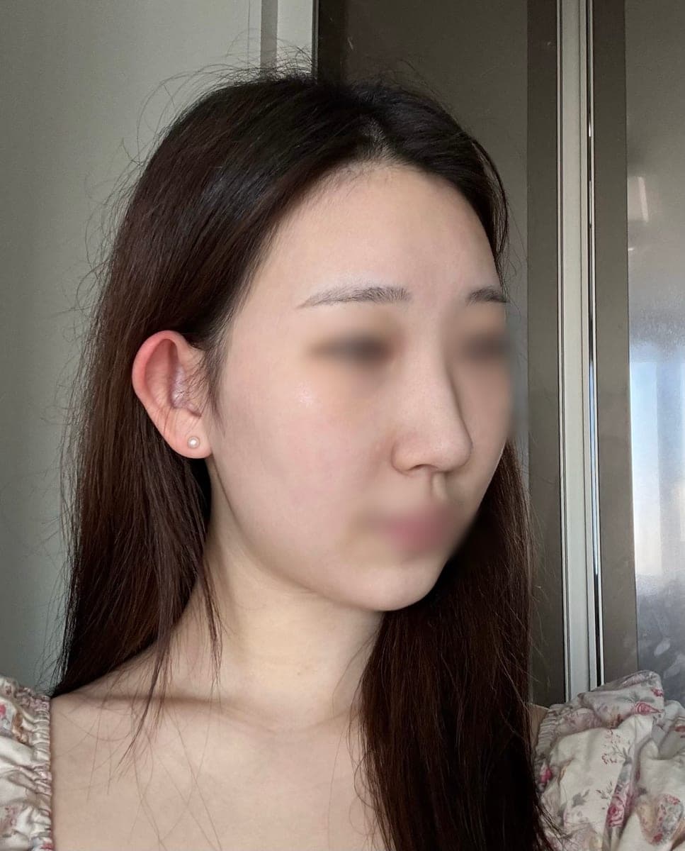 Bulbous tip and nose tip refined together + osteotomy
