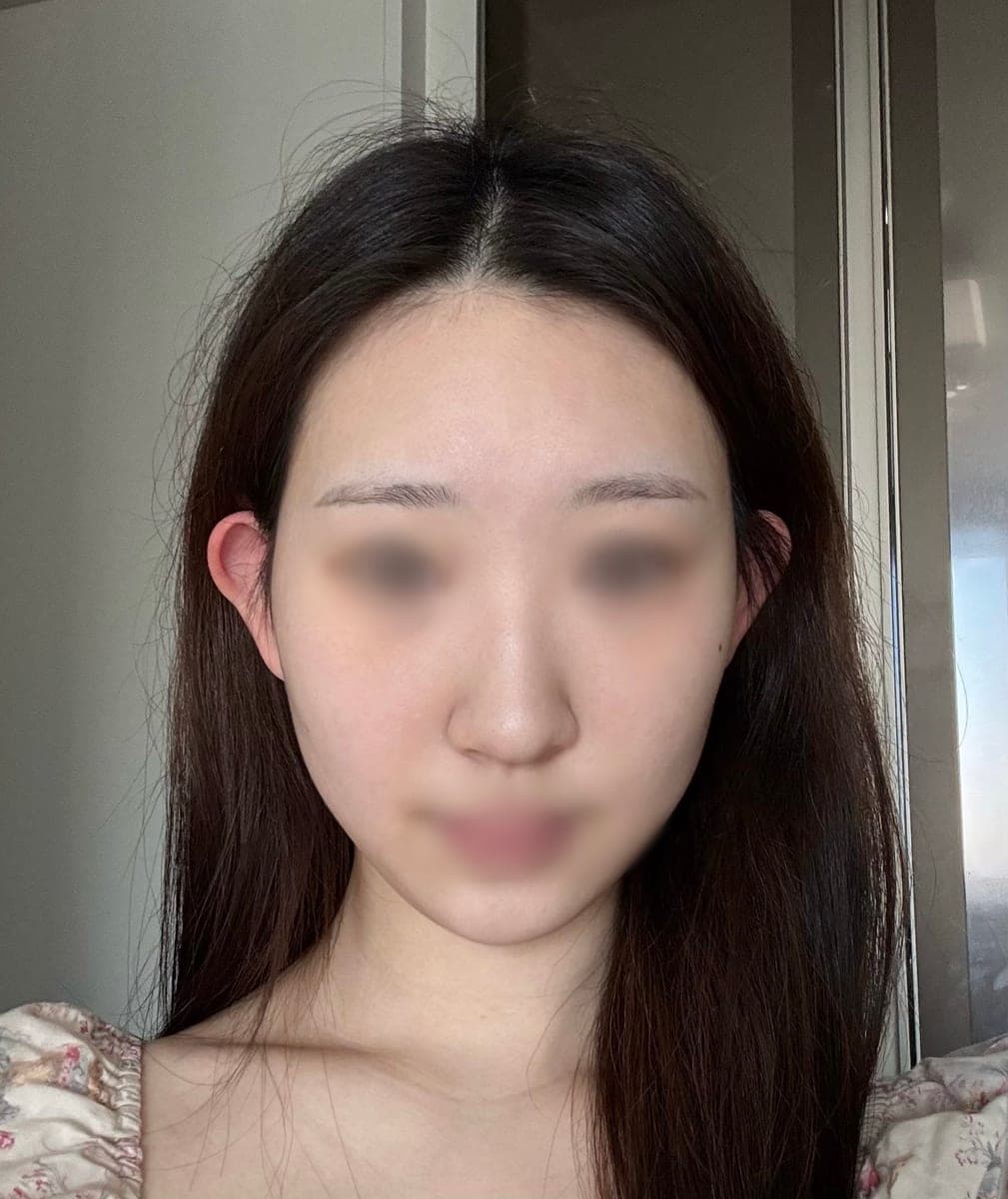 Bulbous tip and nose tip refined together + osteotomy