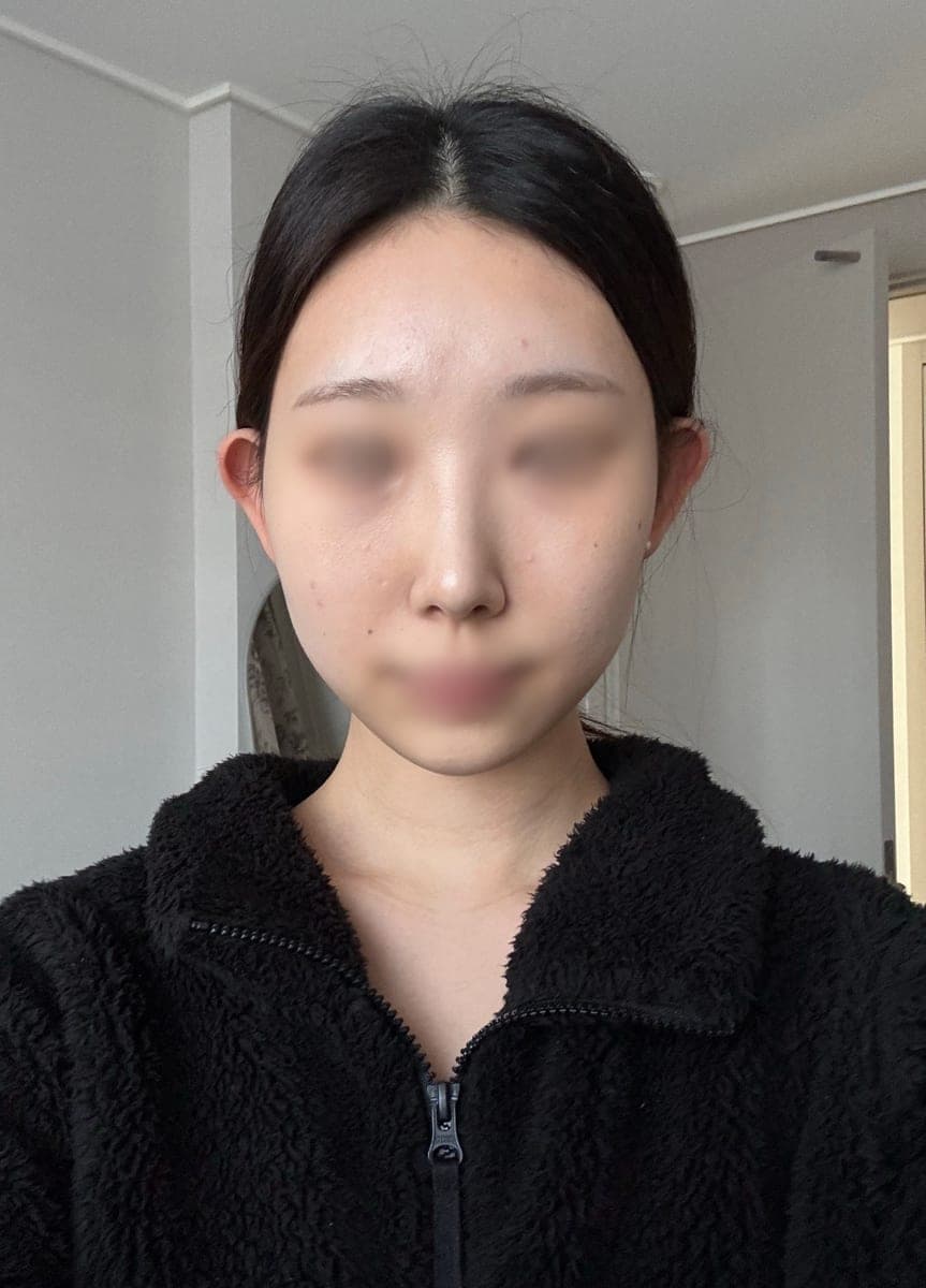 Bulbous tip and nose tip refined together + osteotomy