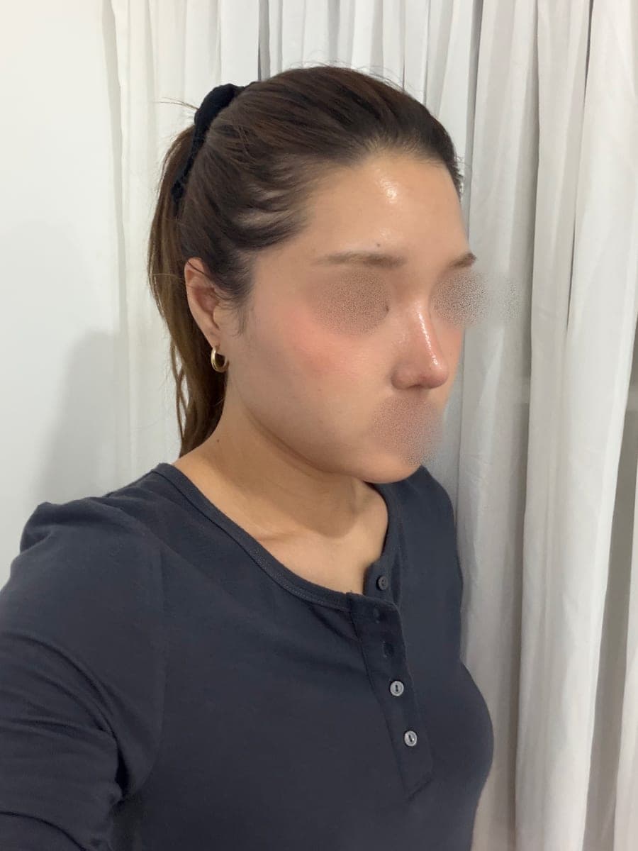 A thick tip made slimmer with own cartilage + osteotomy