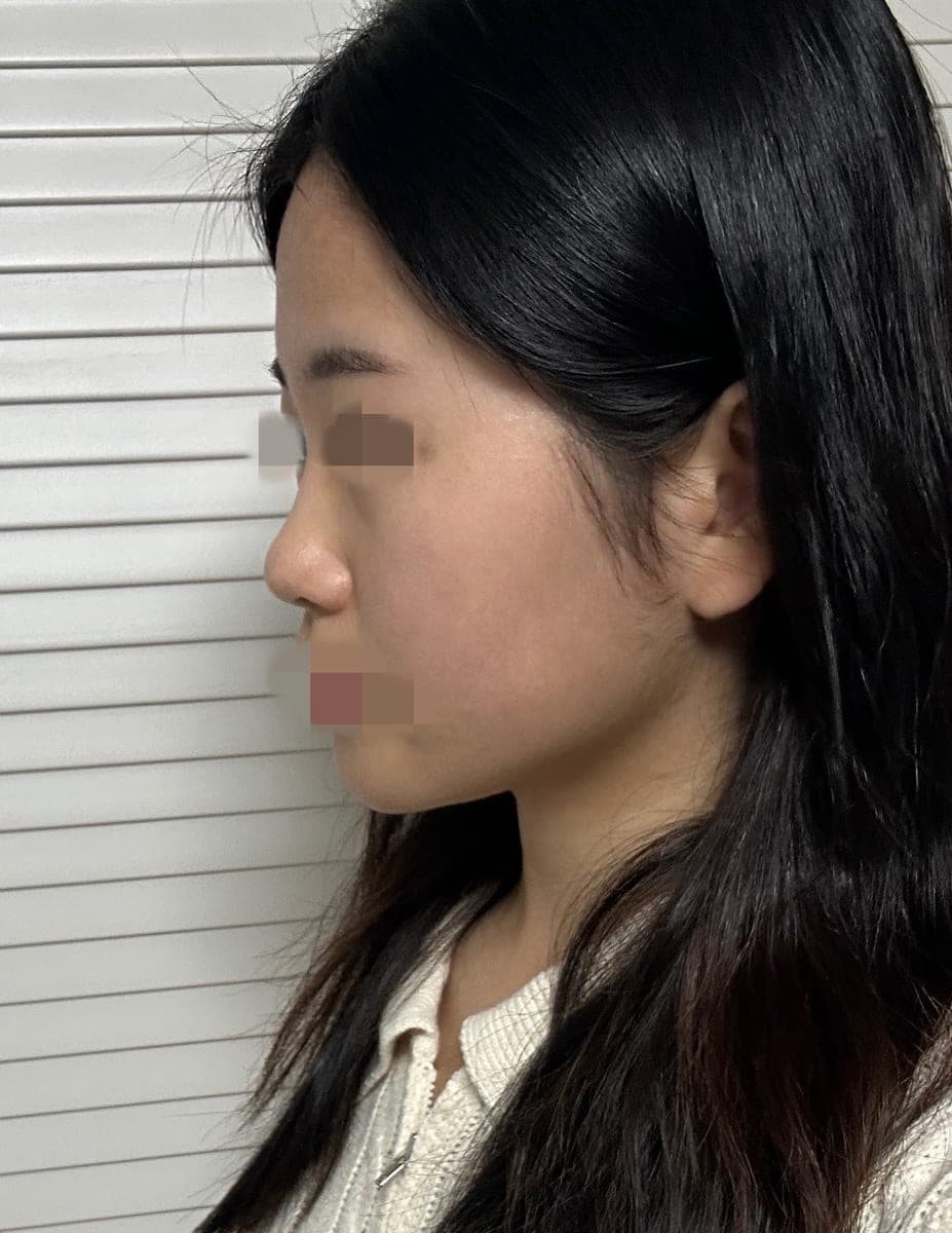 Building the tip with own cartilage