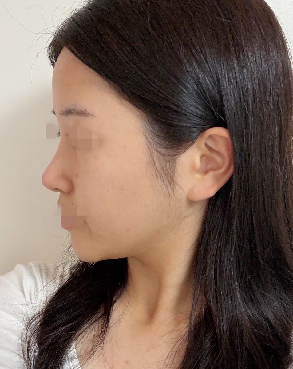 Building the tip with own cartilage