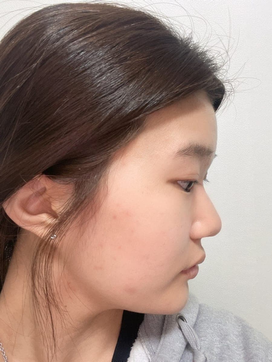 Reshaping the profile line