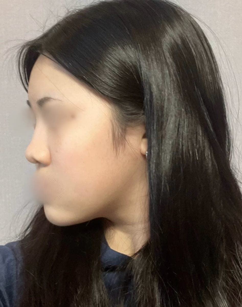 A tip surgery case