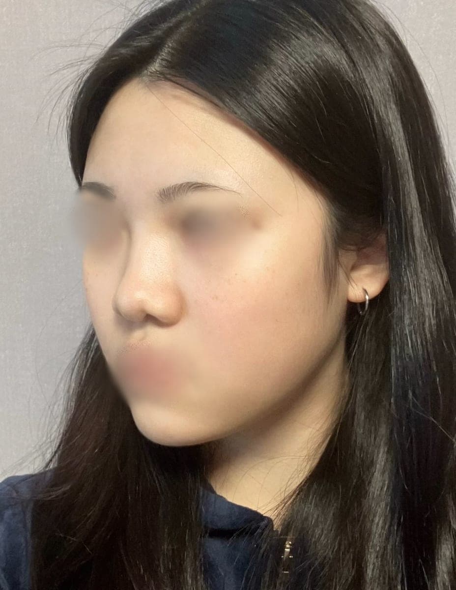 A tip surgery case