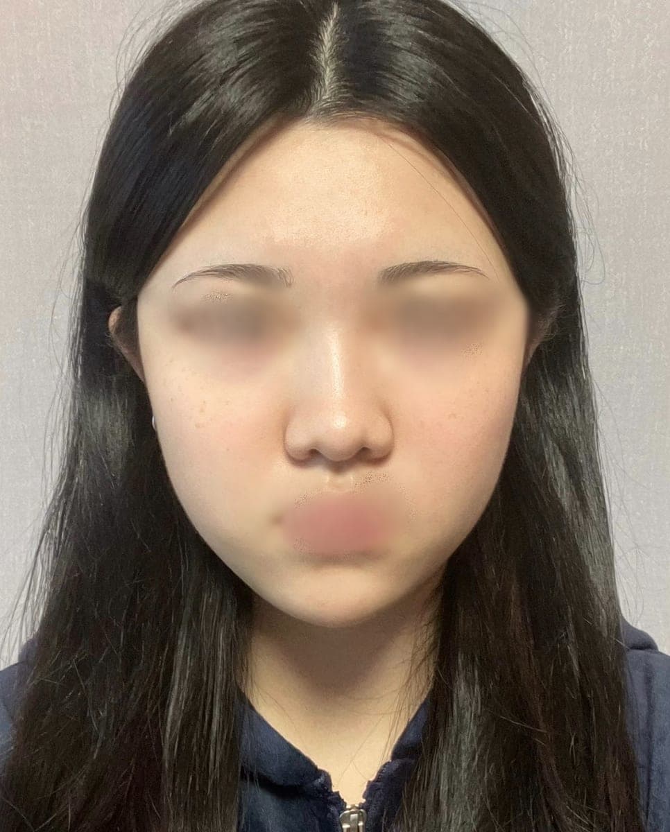 A tip surgery case