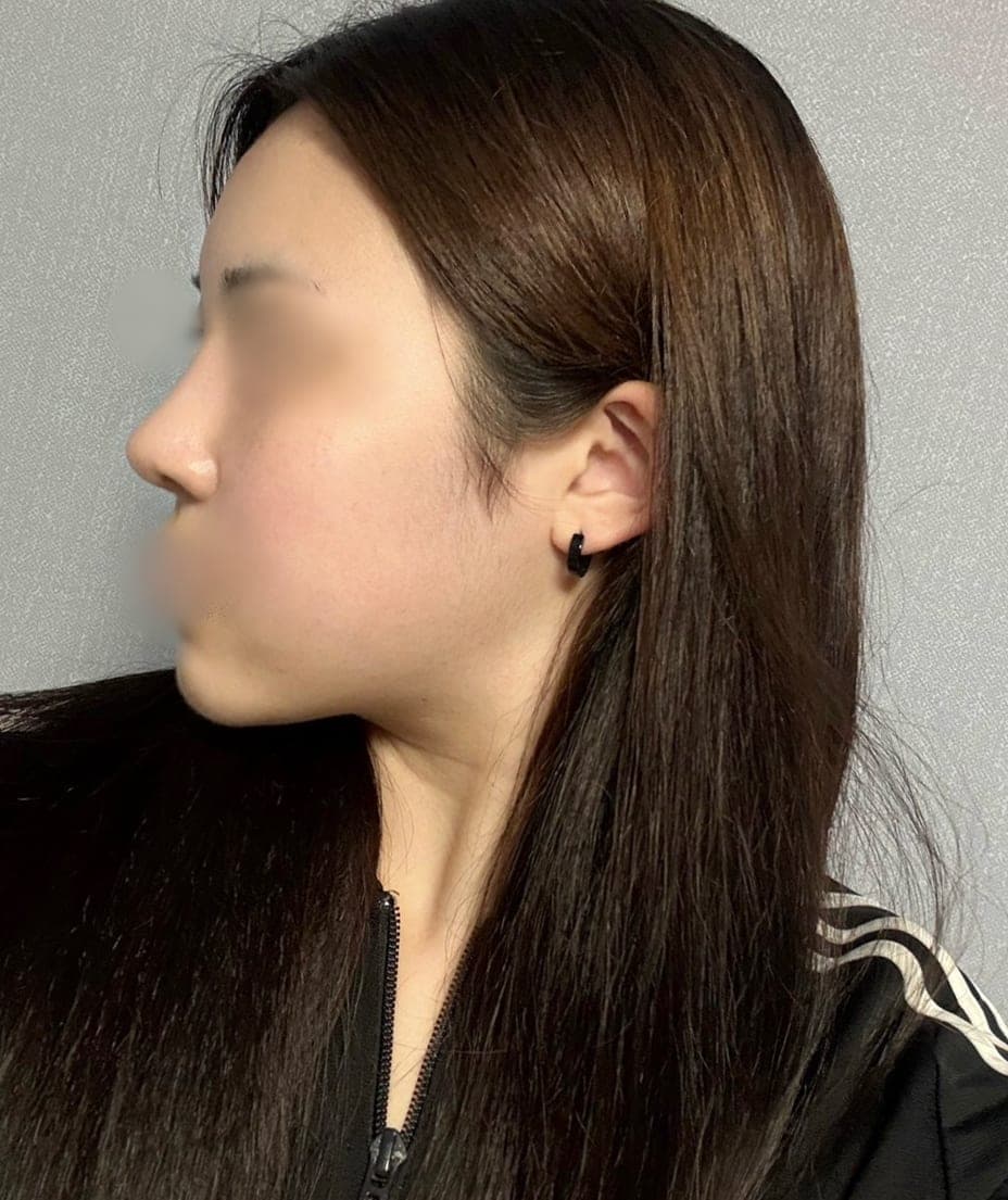 A tip surgery case