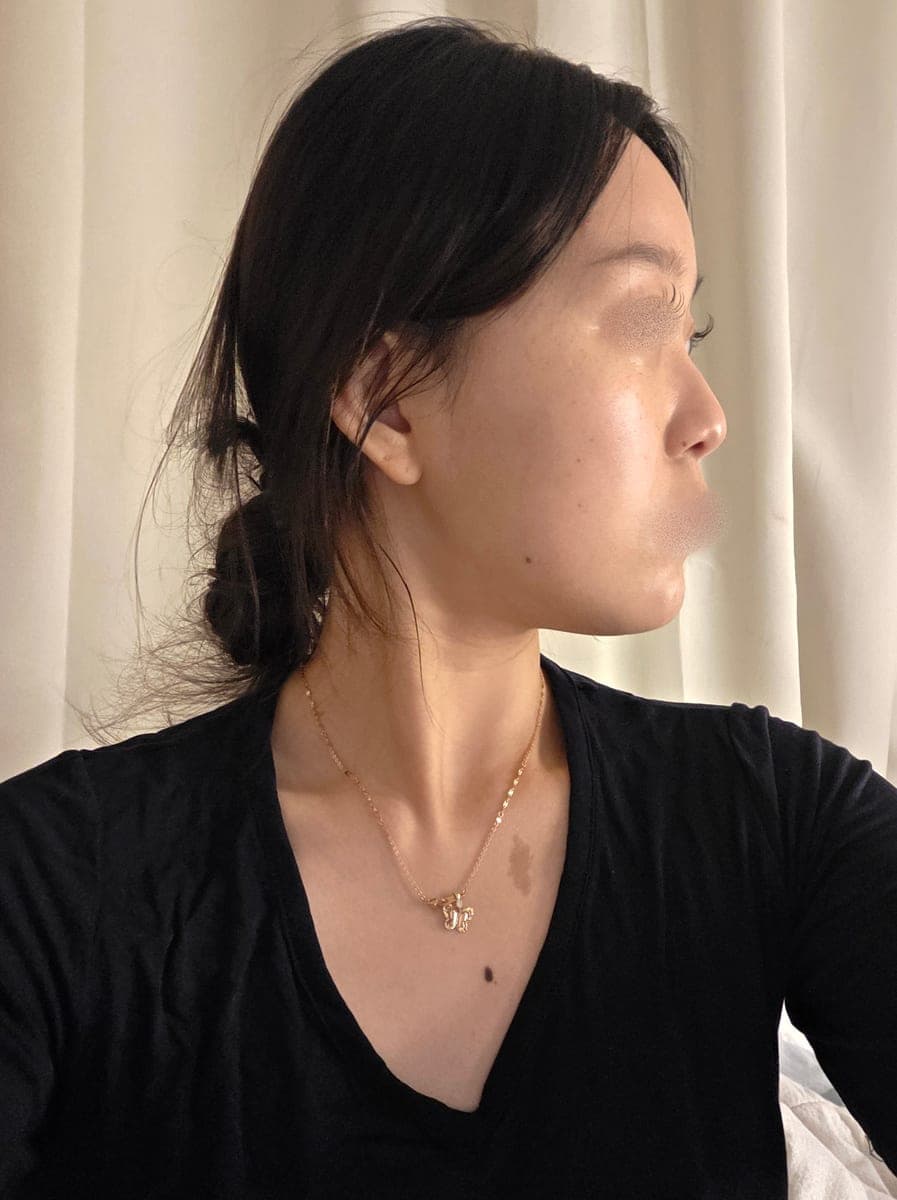 Gathering a wide tip with donor cartilage