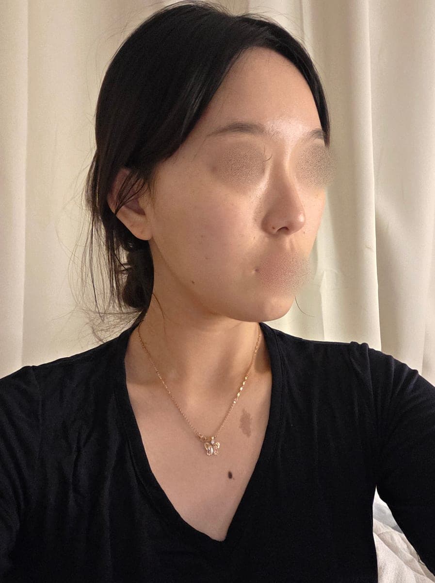 Gathering a wide tip with donor cartilage
