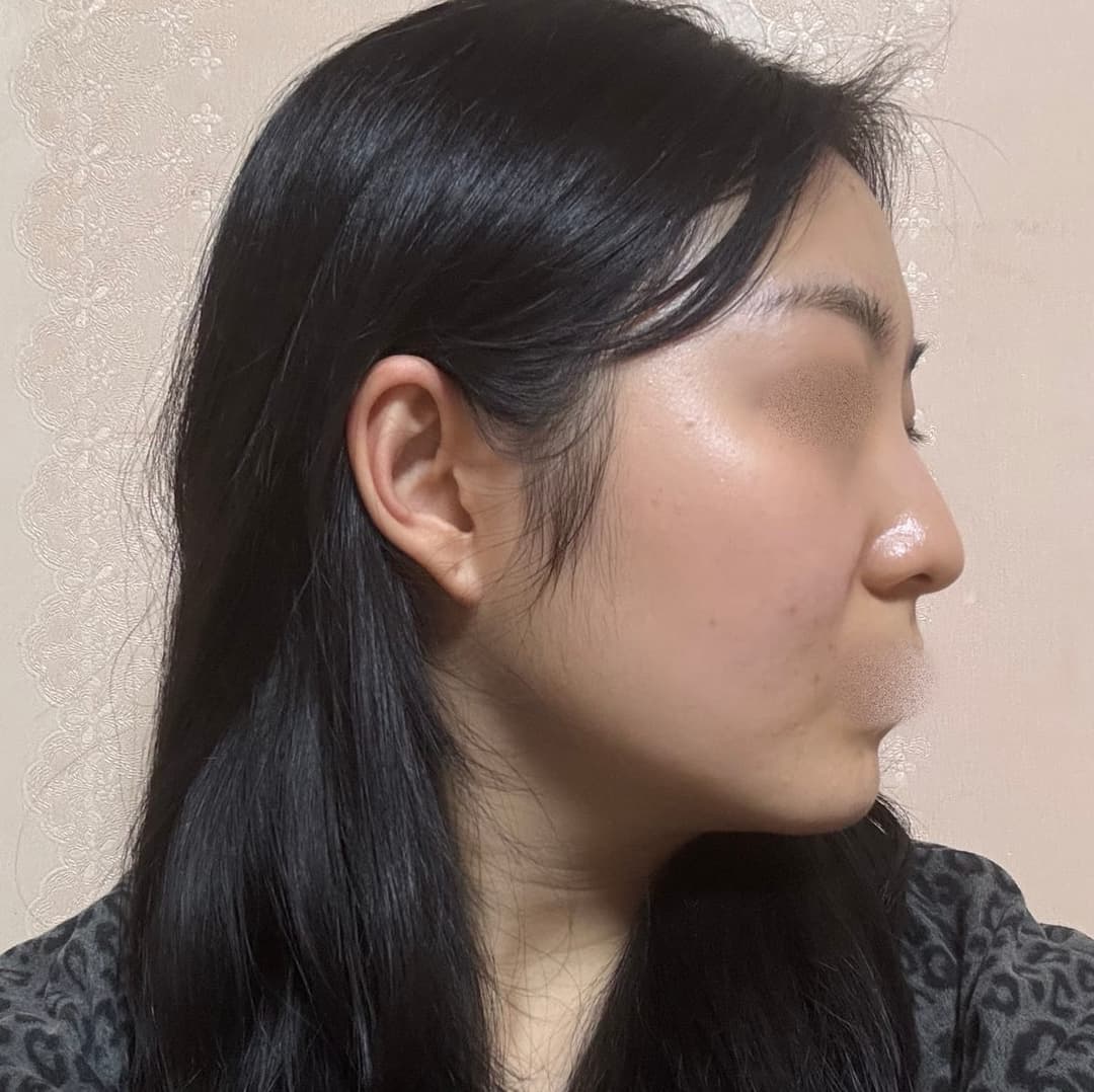 A bulbous nose correction case + osteotomy