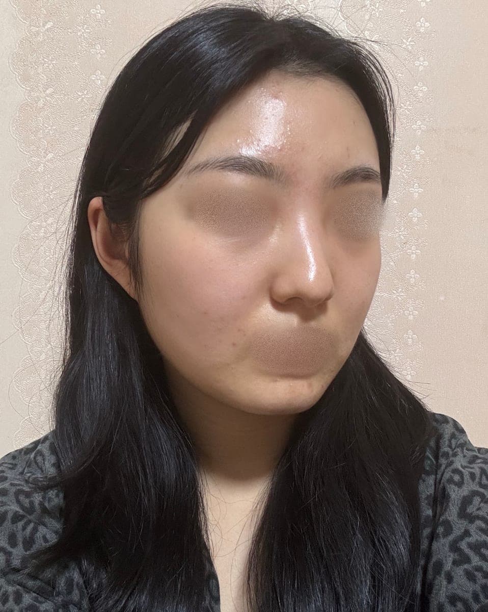 A bulbous nose correction case + osteotomy
