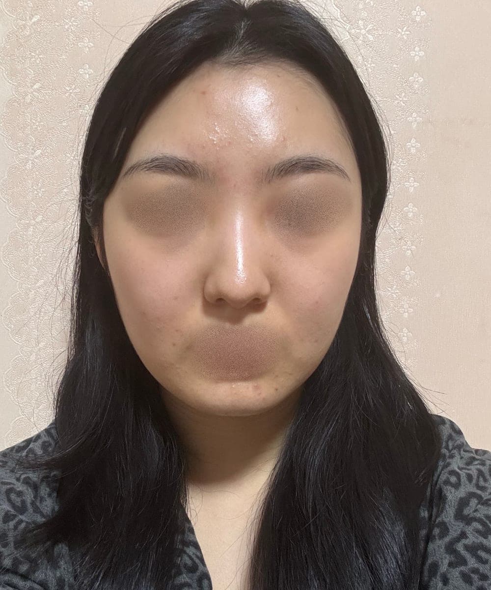 A bulbous nose correction case + osteotomy