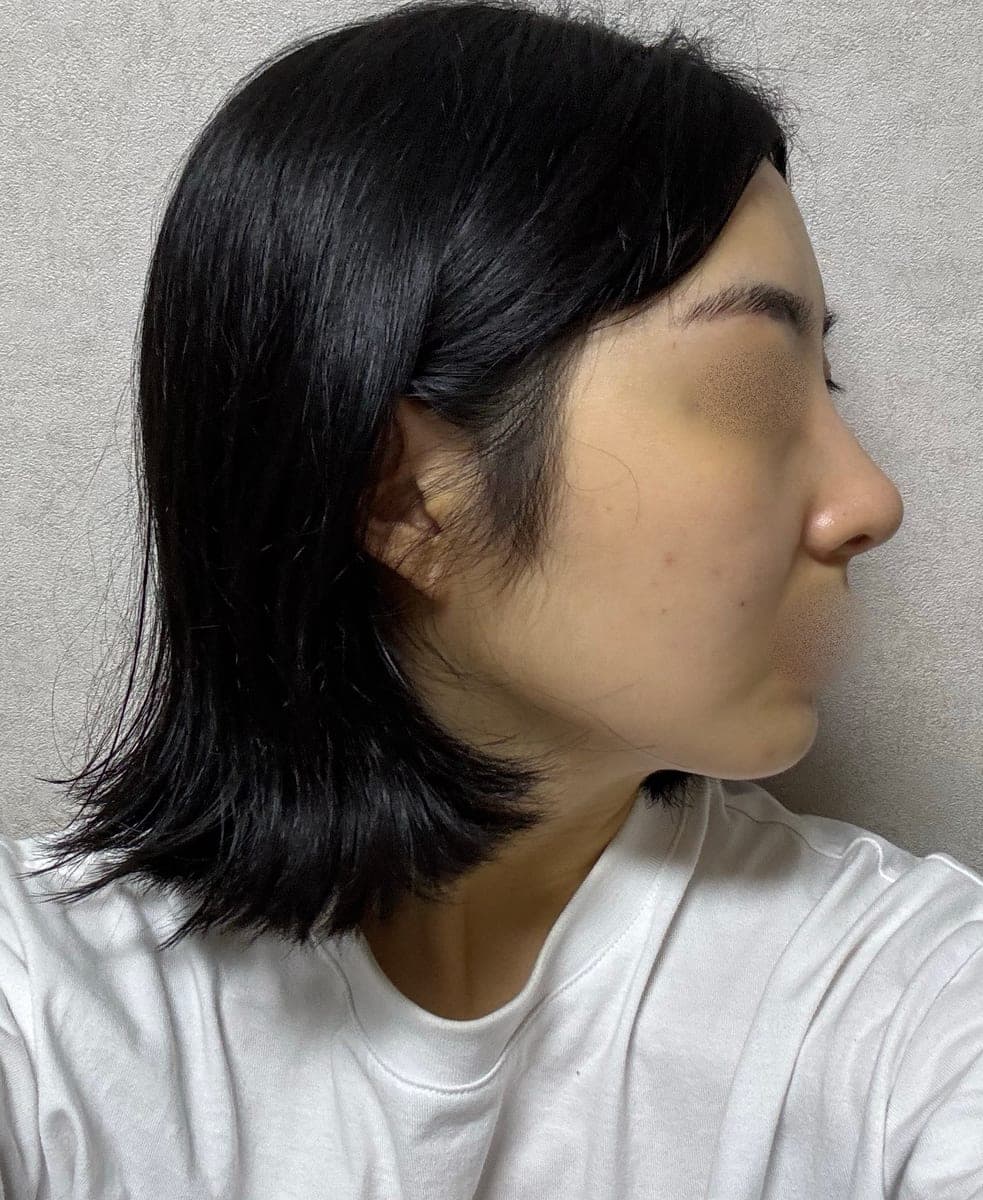 A bulbous nose correction case + osteotomy