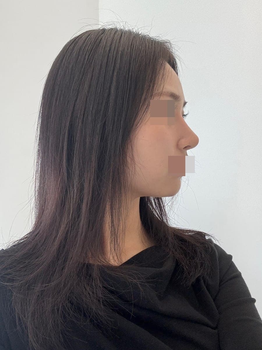 Rebuilding the line in a revision + osteotomy
