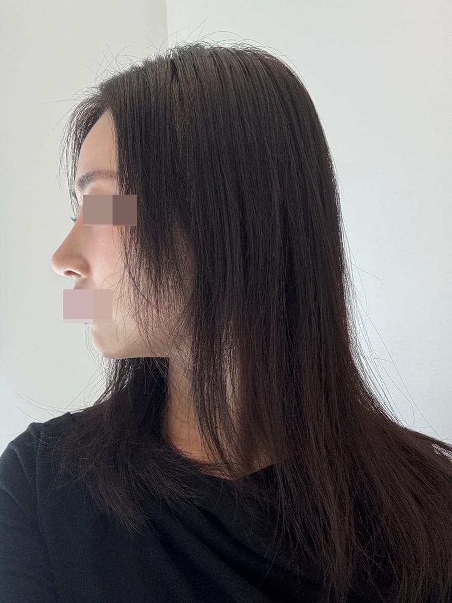 Rebuilding the line in a revision + osteotomy