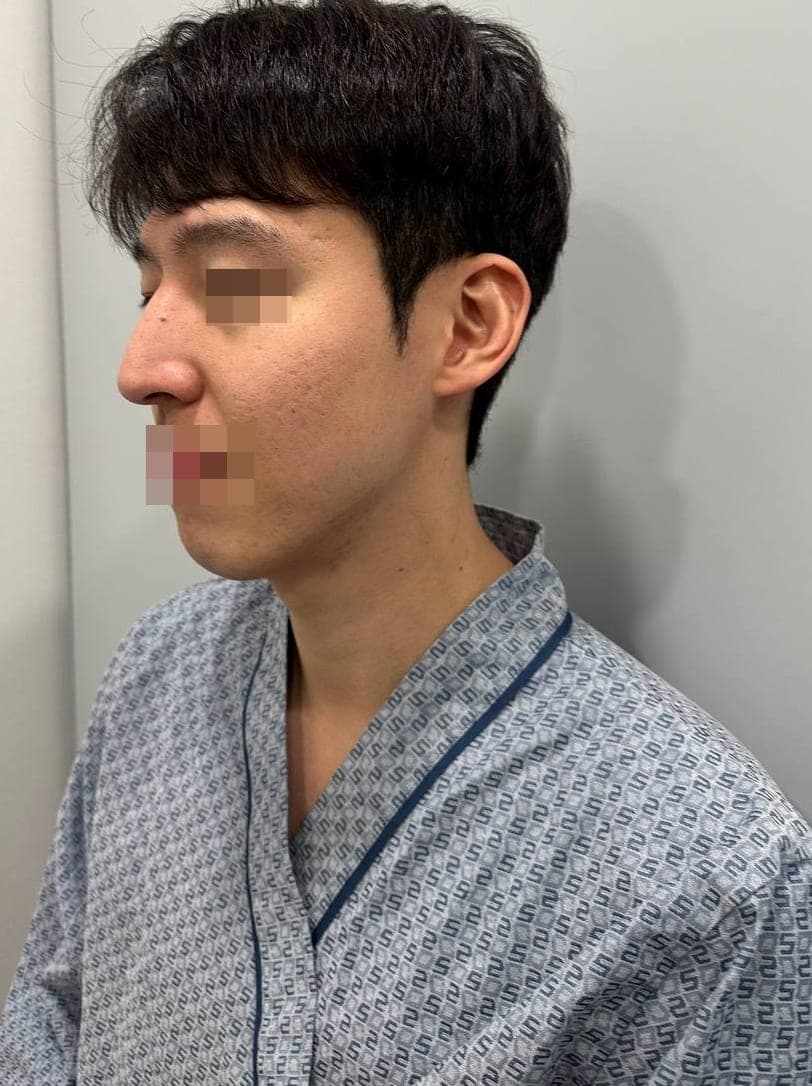 Tip plasty with own cartilage + osteotomy